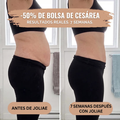Braga Posparto — Compresión 360° — Antes y después 7 semanas