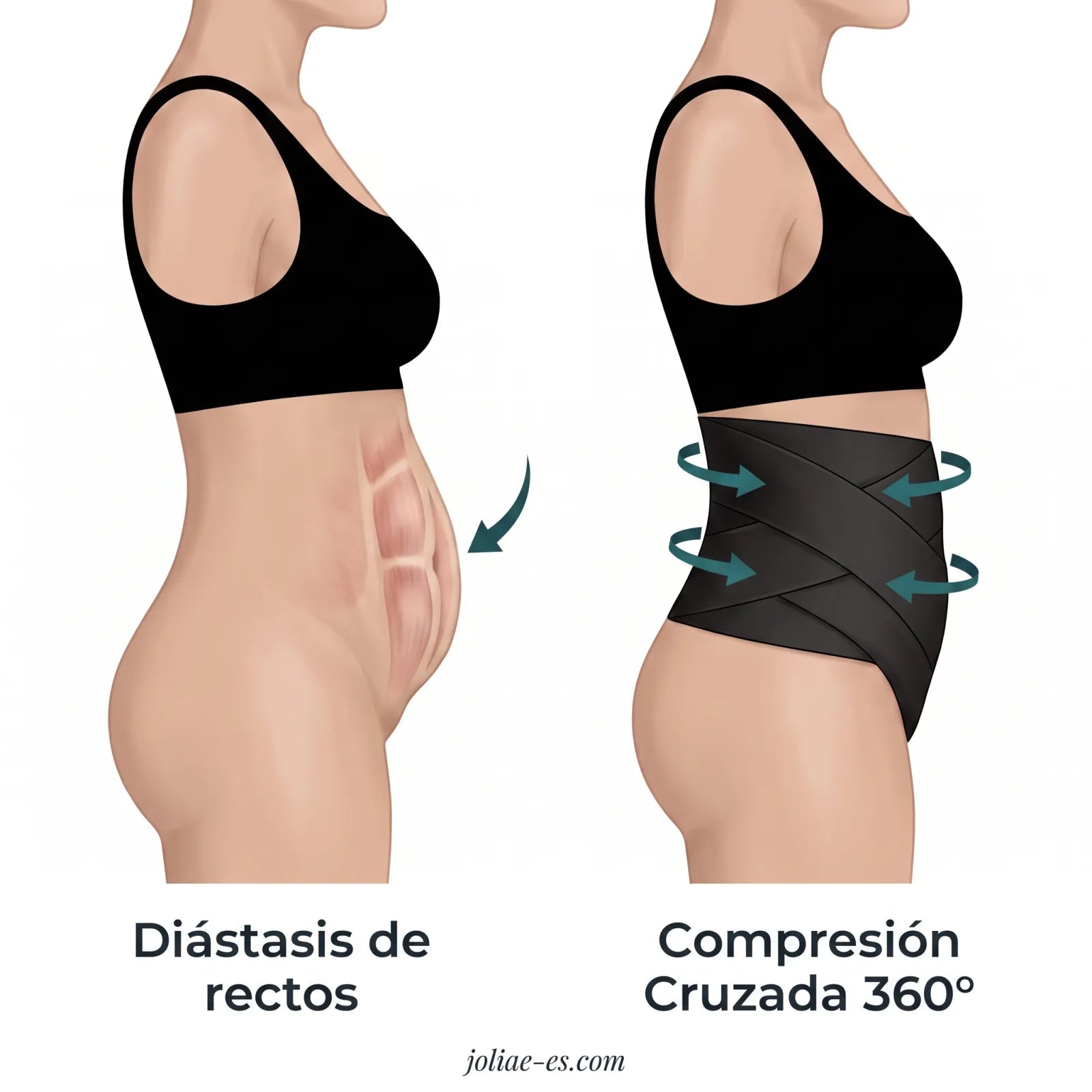 Diástasis de rectos vs compresión cruzada 360°